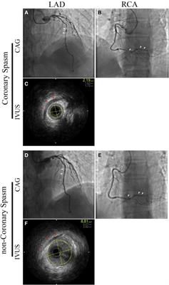 Diagnosis and treatment of coronary spasm in China: a case report